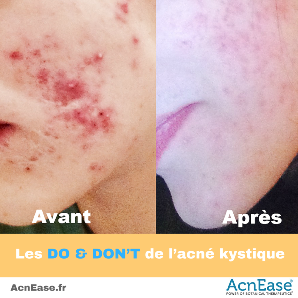 Les DO & DON’T de l’acné kystique